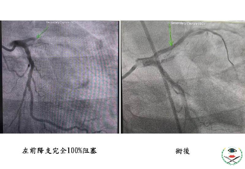 圖1：心導管手術前、後圖示.jpg